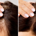Understanding Medical Treatments for Female Hair Loss
