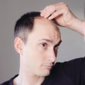 Lifestyle Changes to Prevent Male Pattern Baldness: What You Need to Know