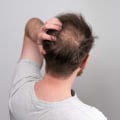 Understanding Finasteride for Hair Loss Treatment
