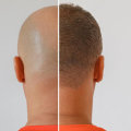 Scalp Camouflage Techniques: A Comprehensive Guide for Hair Loss Solutions
