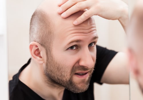 Understanding Genetics and Male Pattern Baldness