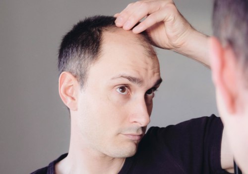 Lifestyle Changes to Prevent Male Pattern Baldness: What You Need to Know