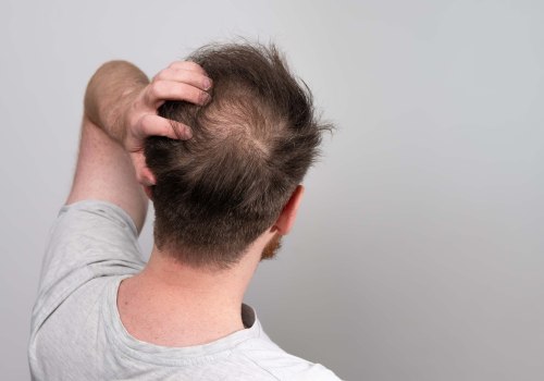 Understanding Finasteride for Hair Loss Treatment
