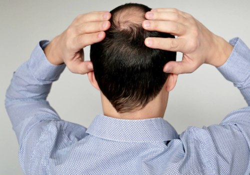 Diagnosing Male Pattern Baldness: A Comprehensive Guide