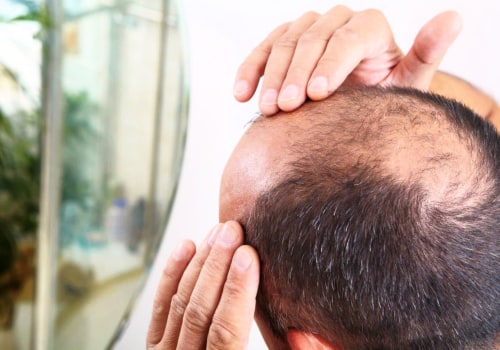 Understanding the Link Between Hormonal Changes and Male Pattern Baldness