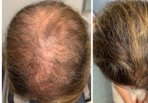 Understanding Minoxidil: The Ultimate Hair Loss Treatment