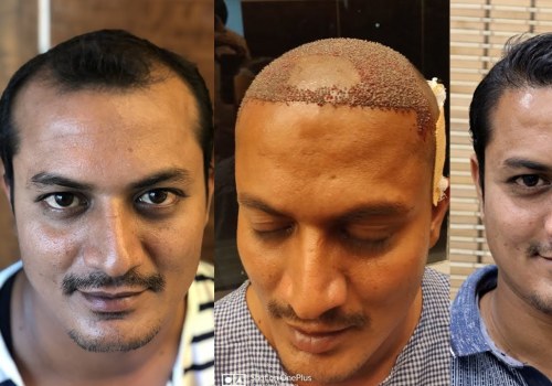 The Truth About Hair Transplants: What You Need to Know